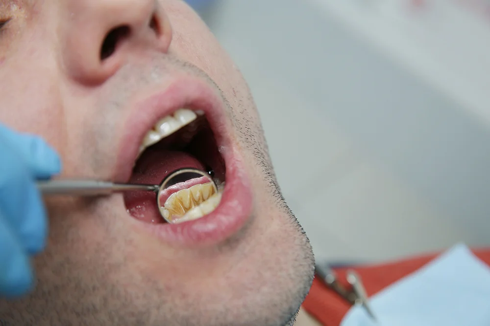 Closeup of mouth with plaque of lower teeth. Dentist examines a patient in a dental clinic. Concept of treatment and care of teeth and oral cavity.