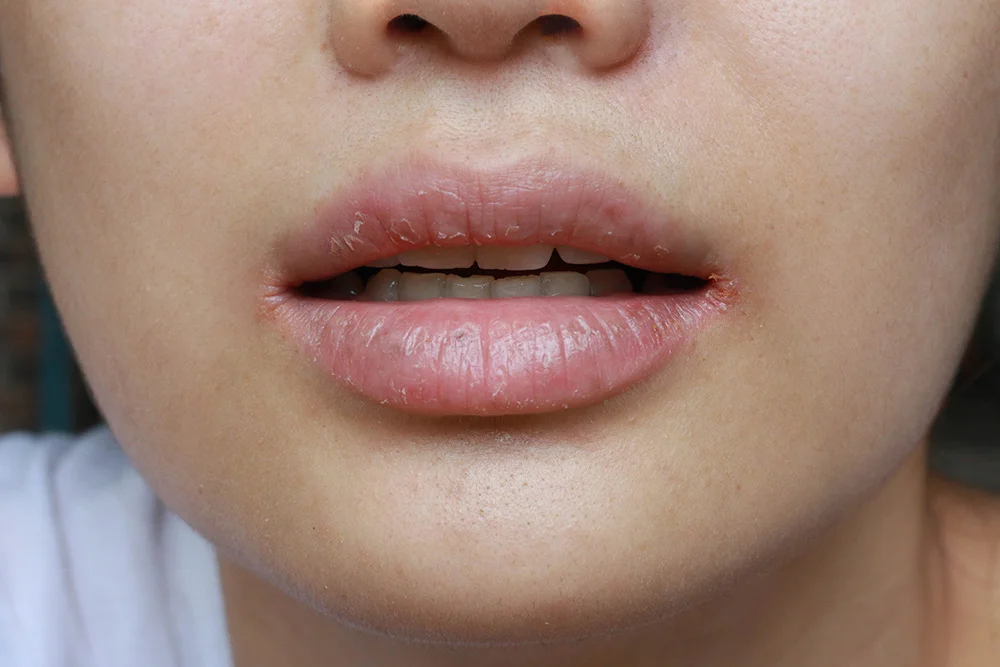 close up of chapped, cracked lips caused wound on the corner of the lips: dry mouth problem with disease, Angular cheilitis
