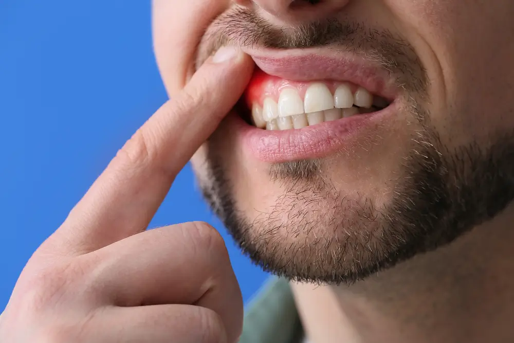 Man with gum inflammation on blue background, closeup abscessed tooth