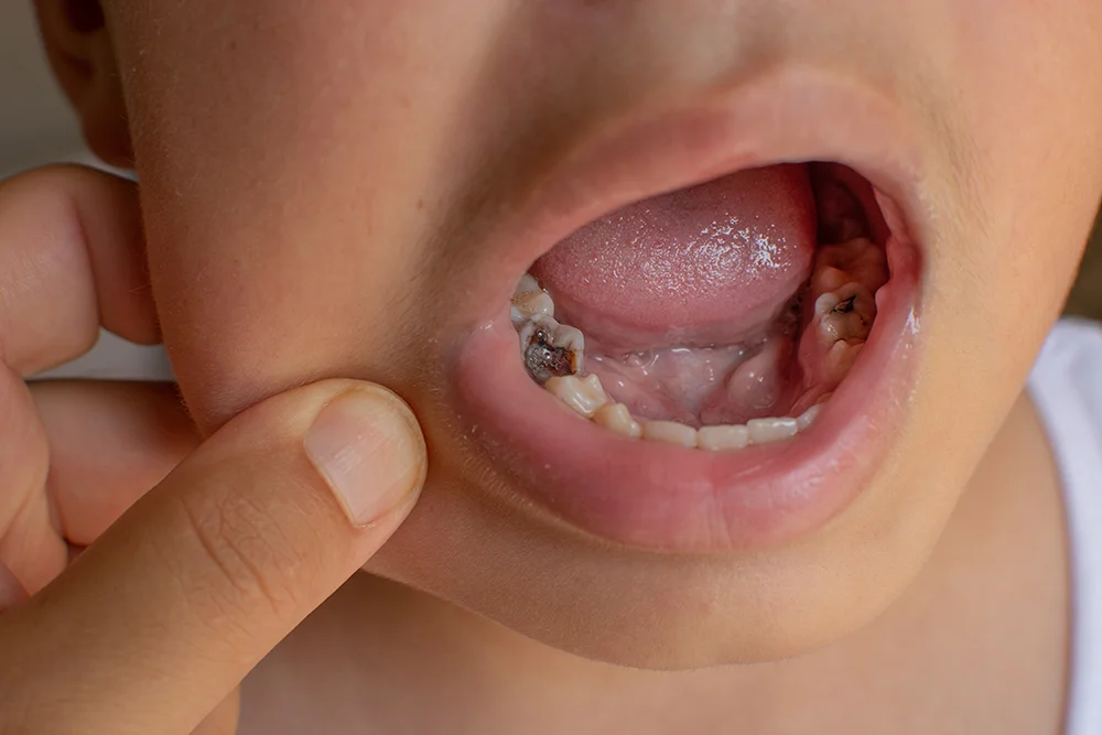 cavities teeth of a child. visual for dentist. cavities and tooth decay