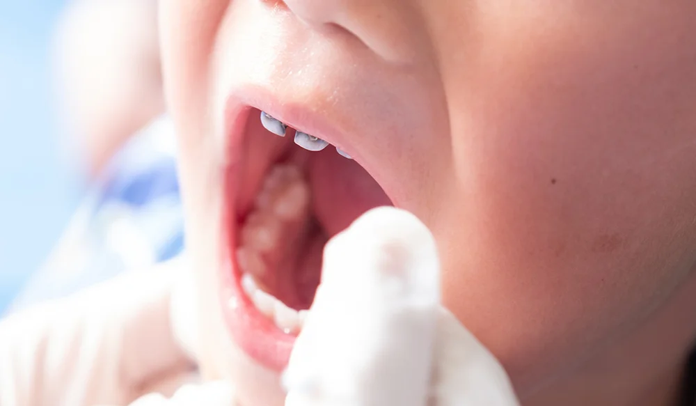 A dentist applies fluoride varnish to children to prevent tooth decay.