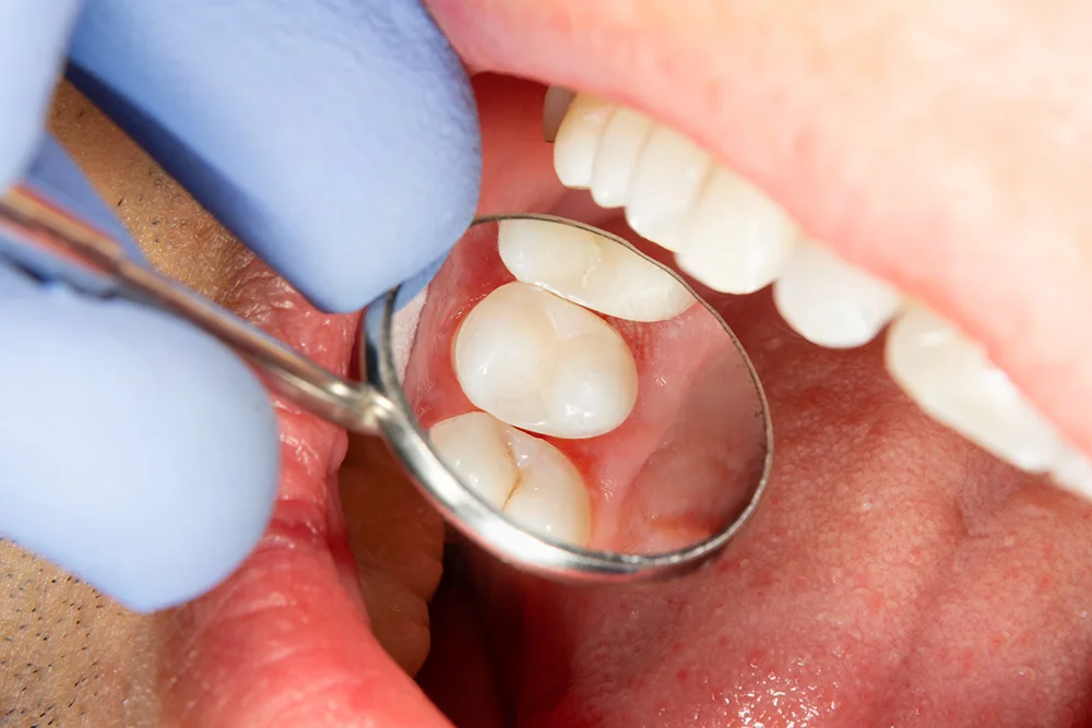 Two chewing side teeth of the upper jaw after treatment of caries. Sealants