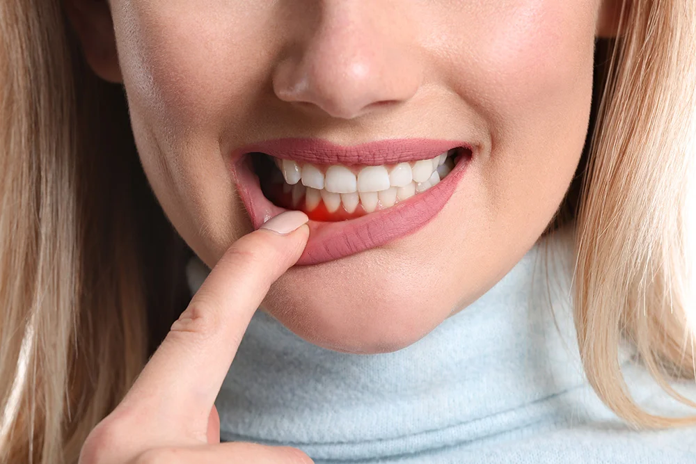 Woman with gum inflammation, closeup, gingivitis