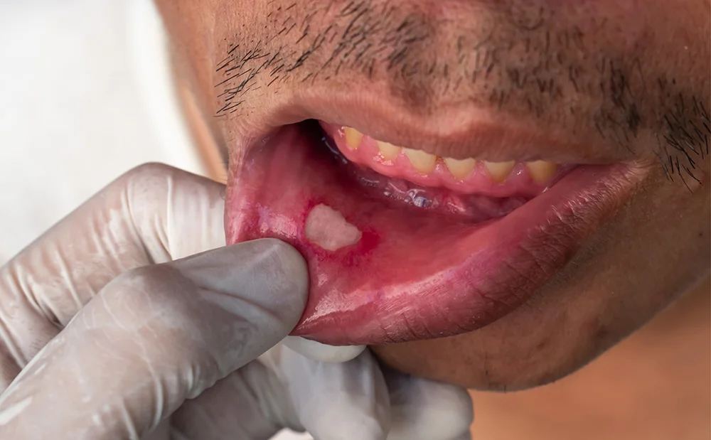 Aphthous ulcer, canker sore or stress ulcer in the mouth of Asian male patient.